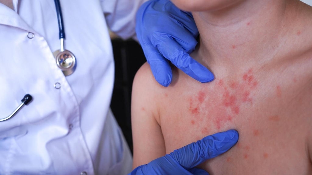 Minnesota's 80 measles cases this year are the most since 1990, health officials say — Woodbury Health news